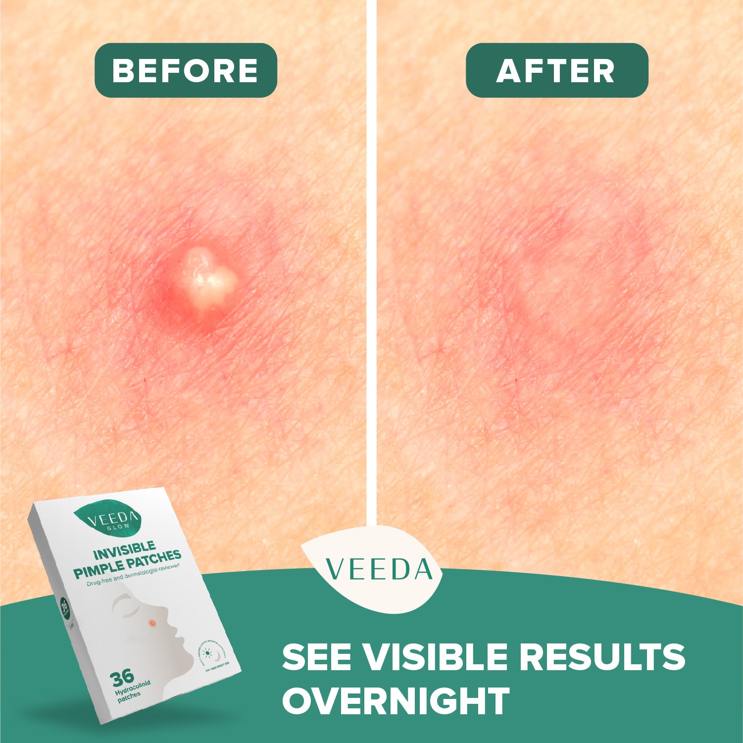 Veeda Glow Invisible Hydrocolloid Pimple Patches